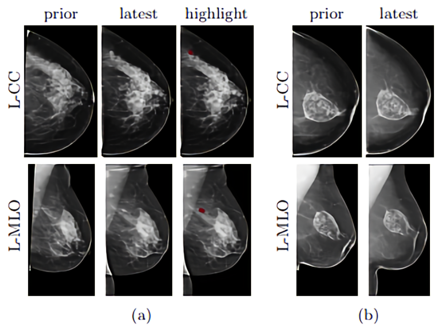深度学习10万张乳房X光照片，这个AI模型要帮助筛查乳腺癌