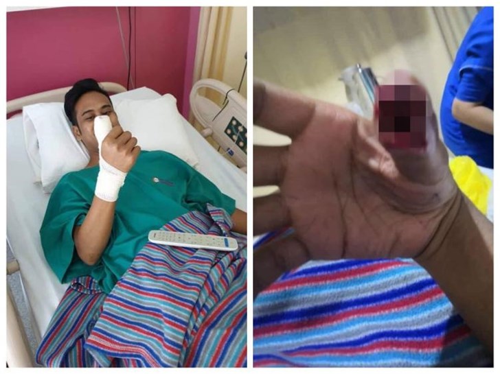 马来西亚一男子因钢化膜破裂继续使用手机致手指发炎
