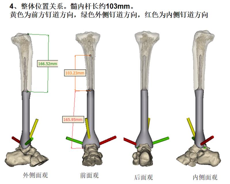 珠江医院林荔军教授团队完成国内首例3D打印胫骨远端假体术