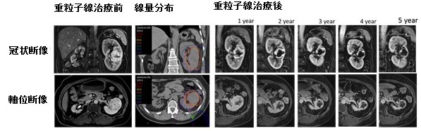 JMT-日本质子重离子之肾细胞癌的重离子（重粒子）线治疗 